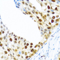 Immunohistochemistry of paraffin-embedded Human prostate cancer using KHDRBS2 Polyclonal Antibody at dilution of 1:100 (40x lens) .