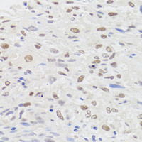 Immunohistochemistry of paraffin-embedded Human lung cancer using HMGN1 Polyclonal Antibody at dilution of 1:100 (40x lens) .