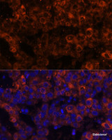 Immunofluorescence analysis of Human liver cancer using SERPINE1 Polyclonal Antibody at dilution of 1:100 (40x lens) . Blue: DAPI for nuclear staining.
