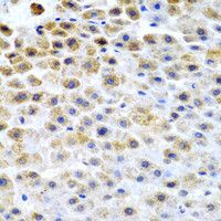 Immunohistochemistry of paraffin-embedded Human liver cancer using TFPI2 Polyclonal Antibody at dilution of 1:200 (40x lens) .
