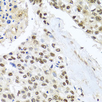 Immunohistochemistry of paraffin-embedded Human lung cancer using BNIP3L Polyclonal Antibody at dilution of 1:100 (40x lens) .