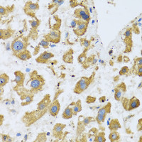 Immunohistochemistry of paraffin-embedded Human liver cancer using BTD Polyclonal Antibody at dilution of 1:100 (40x lens) .