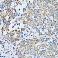 Immunohistochemistry of paraffin-embedded Human lung cancer using RARS Polyclonal Antibody at dilution of 1:100 (40x lens) .