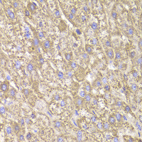 Immunohistochemistry of paraffin-embedded Human liver damage using CIAPIN1 Polyclonal Antibody at dilution of 1:100 (40x lens) .
