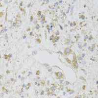 Immunohistochemistry of paraffin-embedded Human gastric cancer using CIAPIN1 Polyclonal Antibody at dilution of 1:100 (40x lens) .