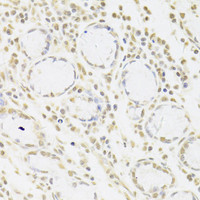 Immunohistochemistry of paraffin-embedded Human gastric cancer using SNRPA Polyclonal Antibody at dilution of 1:100 (40x lens) .