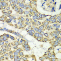 Immunohistochemistry of paraffin-embedded Human esophageal cancer using TUFM Polyclonal Antibody at dilution of 1:100 (40x lens) .