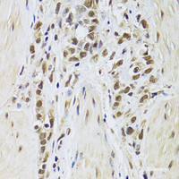 Immunohistochemistry of paraffin-embedded Human gastric cancer using SF1 Polyclonal Antibody at dilution of 1:100 (40x lens) .
