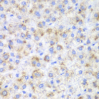 Immunohistochemistry of paraffin-embedded Human liver cancer using HAO1 Polyclonal Antibody at dilution of 1:200 (40x lens) .