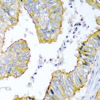 Immunohistochemistry of paraffin-embedded Human colon carcinoma using KRBOX4 Polyclonal Antibody at dilution of 1:200 (40x lens) .