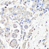 Immunohistochemistry of paraffin-embedded Human breast cancer using BAP1 Polyclonal Antibody at dilution of 1:150 (40x lens) .