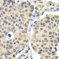 Immunohistochemistry of paraffin-embedded Human lung cancer using CCNC Polyclonal Antibody at dilution of 1:100 (40x lens) .