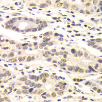Immunohistochemistry of paraffin-embedded Human colon carcinoma using CCNC Polyclonal Antibody at dilution of 1:100 (40x lens) .