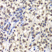 Immunohistochemistry of paraffin-embedded Human kidney cancer using CENPC Polyclonal Antibody at dilution of 1:200 (40x lens) .