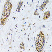 Immunohistochemistry of paraffin-embedded Human breast cancer using CIRBP Polyclonal Antibody at dilution of 1:100 (40x lens) .