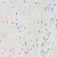 Immunohistochemistry of paraffin-embedded Human gastric cancer using CSRP3 Polyclonal Antibody at dilution of 1:100 (40x lens) .