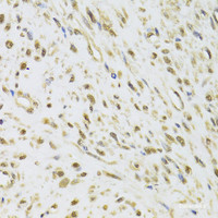 Immunohistochemistry of paraffin-embedded Human leiomyoma of uterus using DDX1 Polyclonal Antibody at dilution of 1:100 (40x lens) .