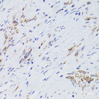 Immunohistochemistry of paraffin-embedded Human gastric cancer using GATM Polyclonal Antibody at dilution of 1:100 (40x lens) .