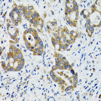 Immunohistochemistry of paraffin-embedded Human colon carcinoma using HYOU1 Polyclonal Antibody at dilution of 1:100 (40x lens) .