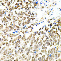 Immunohistochemistry of paraffin-embedded Human lung cancer using PNKP Polyclonal Antibody at dilution of 1:100 (40x lens) .