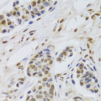 Immunohistochemistry of paraffin-embedded Human breast cancer using PPP1R8 Polyclonal Antibody at dilution of 1:100 (40x lens) .