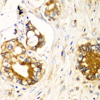 Immunohistochemistry of paraffin-embedded Human liver cancer using RPN1 Polyclonal Antibody at dilution of 1:100 (40x lens) .