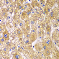 Immunohistochemistry of paraffin-embedded Human liver damage using RPN1 Polyclonal Antibody at dilution of 1:100 (40x lens) .