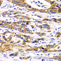 Immunohistochemistry of paraffin-embedded Human gastric cancer using RPN1 Polyclonal Antibody at dilution of 1:100 (40x lens) .