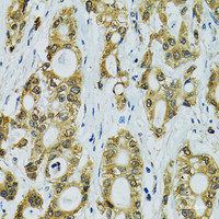 Immunohistochemistry of paraffin-embedded Human rectal cancer using RPS7 Polyclonal Antibody at dilution of 1:100 (40x lens) .