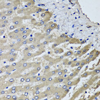 Immunohistochemistry of paraffin-embedded Human liver damage using SCYL1 Polyclonal Antibody at dilution of 1:100 (40x lens) .