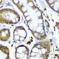 Immunohistochemistry of paraffin-embedded Human colon carcinoma using SECISBP2 Polyclonal Antibody at dilution of 1:200 (40x lens) .