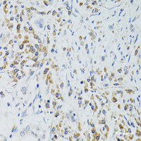 Immunohistochemistry of paraffin-embedded Human colon carcinoma using SRP19 Polyclonal Antibody at dilution of 1:100 (40x lens) .