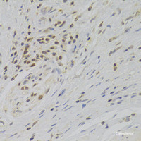 Immunohistochemistry of paraffin-embedded Human gastric cancer using TAF1C Polyclonal Antibody at dilution of 1:100 (40x lens) .