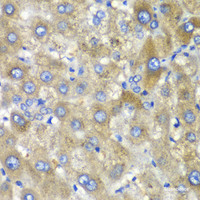 Immunohistochemistry of paraffin-embedded Human liver damage using TLK2 Polyclonal Antibody at dilution of 1:100 (40x lens) .