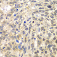 Immunohistochemistry of paraffin-embedded Human esophageal cancer using TLK2 Polyclonal Antibody at dilution of 1:100 (40x lens) .