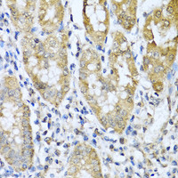 Immunohistochemistry of paraffin-embedded Human gastric cancer using ASIP Polyclonal Antibody at dilution of 1:100 (40x lens) .