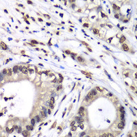 Immunohistochemistry of paraffin-embedded Human liver cancer using HNRNPM Polyclonal Antibody at dilution of 1:100 (40x lens) .