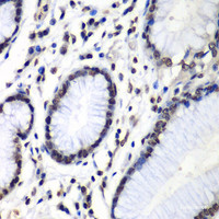 Immunohistochemistry of paraffin-embedded Human colon carcinoma using HNRNPM Polyclonal Antibody at dilution of 1:100 (40x lens) .
