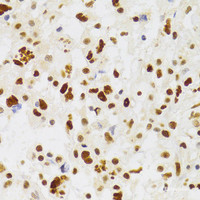 Immunohistochemistry of paraffin-embedded Human brain astrocytoma using NASP Polyclonal Antibody at dilution of 1:100 (40x lens) .