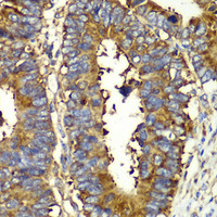 Immunohistochemistry of paraffin-embedded Human colon carcinoma using QARS Polyclonal Antibody at dilution of 1:100 (40x lens) .