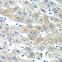 Immunohistochemistry of paraffin-embedded Human liver damage using QARS Polyclonal Antibody at dilution of 1:100 (40x lens) .