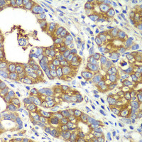 Immunohistochemistry of paraffin-embedded Human gastric cancer using QARS Polyclonal Antibody at dilution of 1:100 (40x lens) .