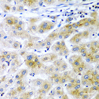 Immunohistochemistry of paraffin-embedded Human liver cancer using RARRES2 Polyclonal Antibody at dilution of 1:200 (40x lens) .