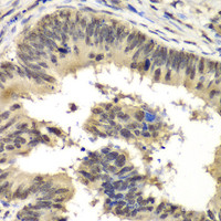 Immunohistochemistry of paraffin-embedded Human colon carcinoma using RBBP5 Polyclonal Antibody at dilution of 1:100 (40x lens) .