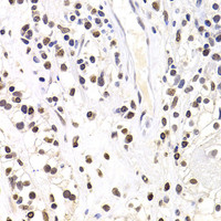 Immunohistochemistry of paraffin-embedded Human kidney cancer using SOX5 Polyclonal Antibody at dilution of 1:100 (40x lens) .