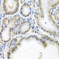 Immunohistochemistry of paraffin-embedded Human colon carcinoma using SSX2 Polyclonal Antibody at dilution of 1:200 (40x lens) .