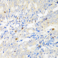 Immunohistochemistry of paraffin-embedded Human rectal cancer using STAT4 Polyclonal Antibody at dilution of 1:100 (40x lens) .