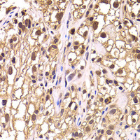 Immunohistochemistry of paraffin-embedded Human kidney cancer using TCEB3 Polyclonal Antibody at dilution of 1:100 (40x lens) .