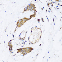 Immunohistochemistry of paraffin-embedded Human breast cancer using NAA10 Polyclonal Antibody at dilution of 1:100 (40x lens) .