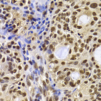 Immunohistochemistry of paraffin-embedded Human oophoroma using HIRIP3 Polyclonal Antibody at dilution of 1:100 (40x lens) .